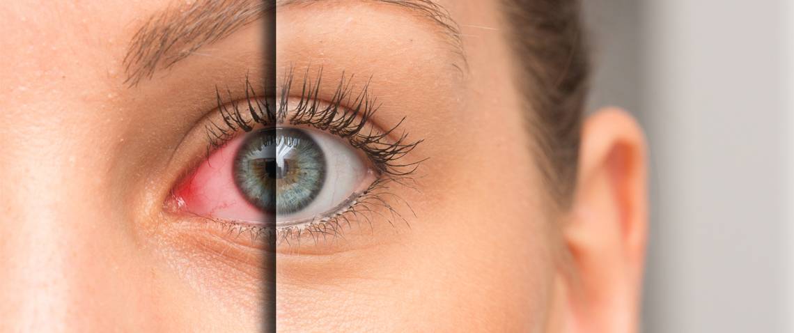 IPL Therapy for Dry Eyes img